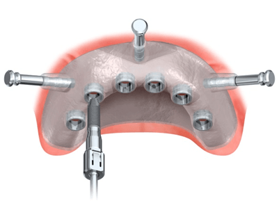 Implantologische OP-Bohrschablone